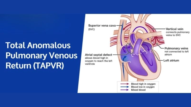 Total anomalous pulmonary venous return symptoms explained