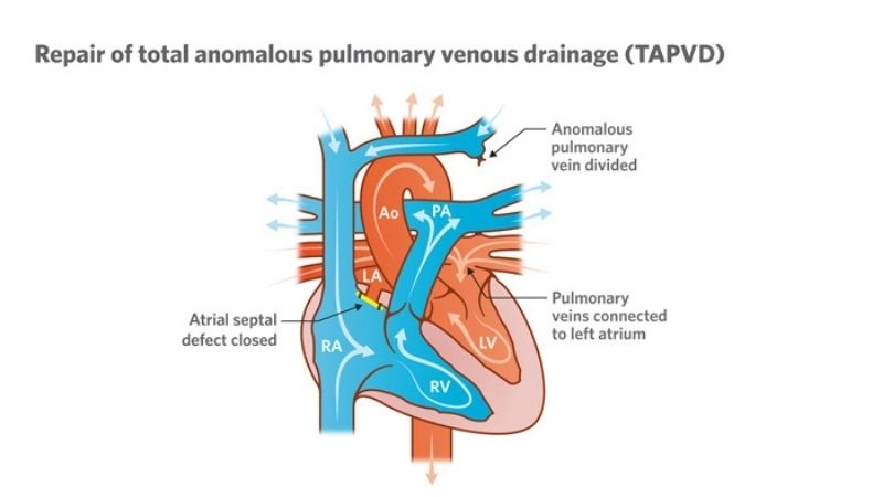 Total anomalous pulmonary venous return diagnosis and testing