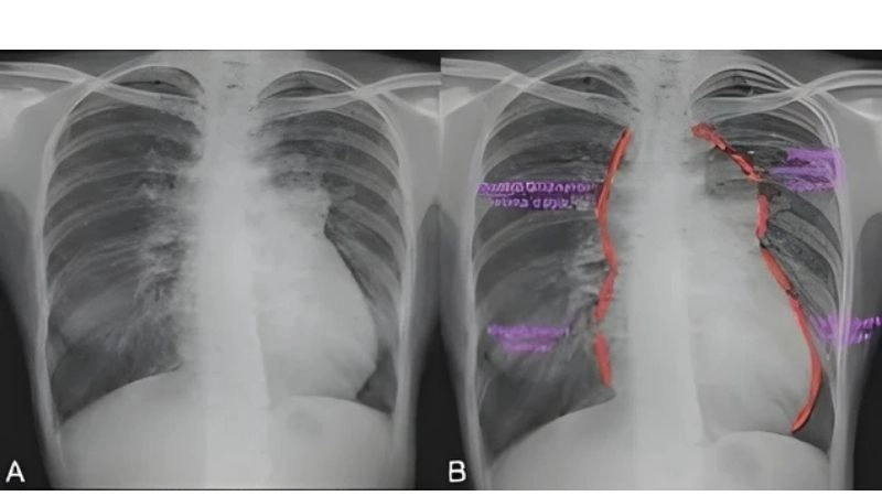 Types of total anomalous pulmonary venous return conditions