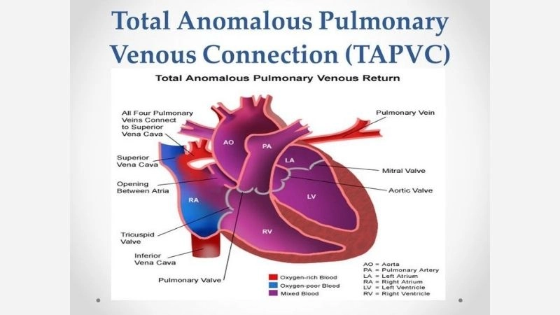 Total anomalous pulmonary venous return prognosis survival
