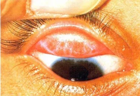 A diagram explaining what is trachoma and its progression