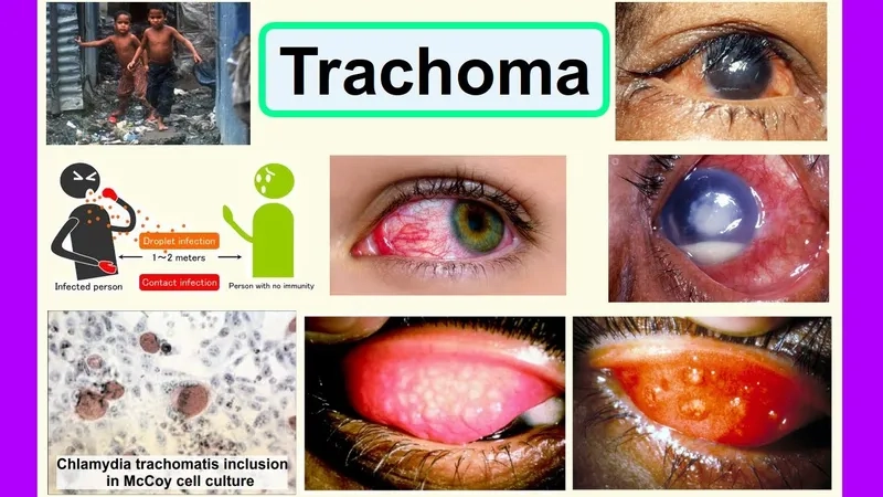 Explaining the WHO's SAFE strategy for trachoma