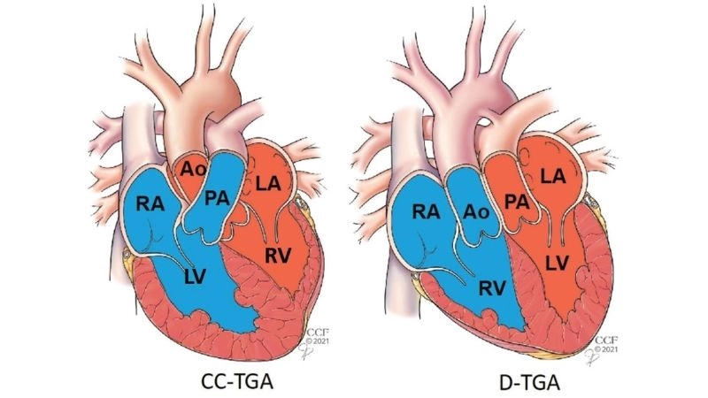 Transposition of the great arteries symptoms early cyanosis in babies