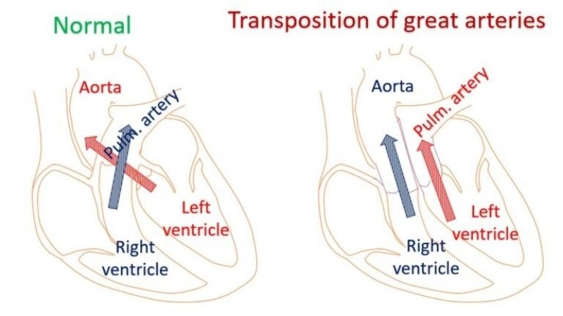 Transposition of the great arteries treatment options for survival