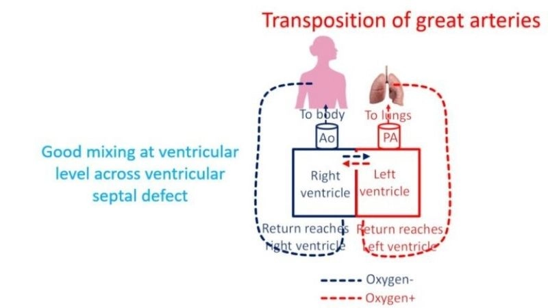 Living with transposition of the great arteries long term heart care