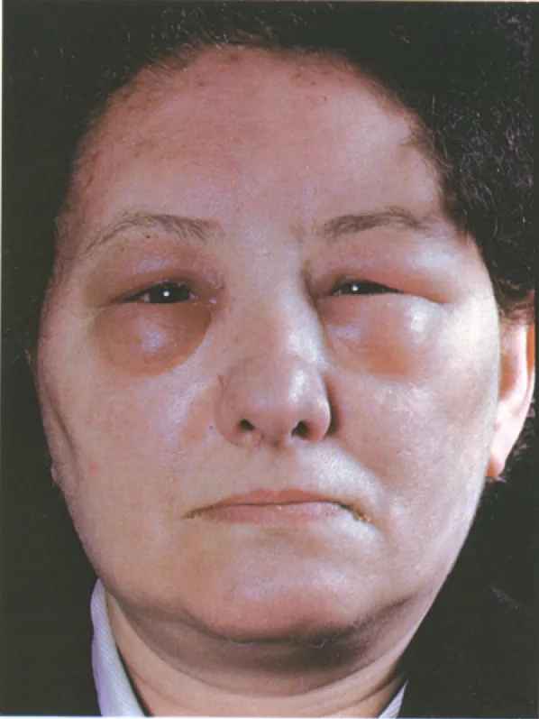 Effective methods for trichinosis treatment