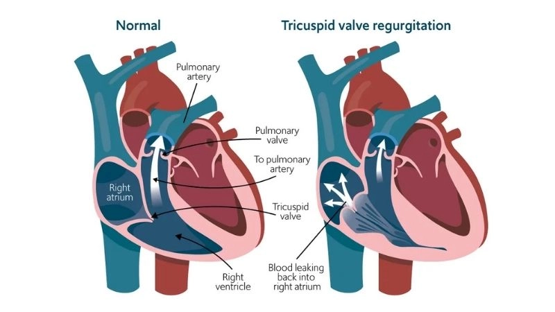 Tricuspid Regurgitation Treatment may involve medications or surgery