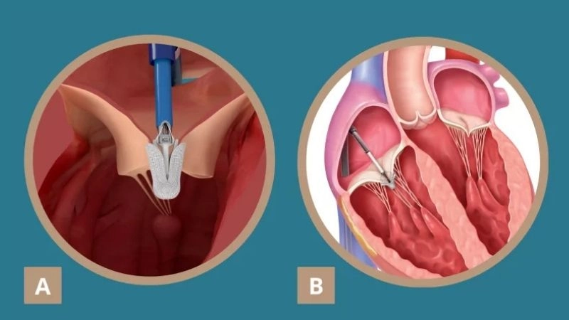 Tricuspid Valve Regurgitation affects blood flow in the right heart