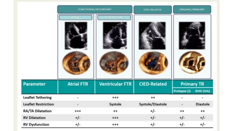 Severe Tricuspid Regurgitation can lead to right heart failure