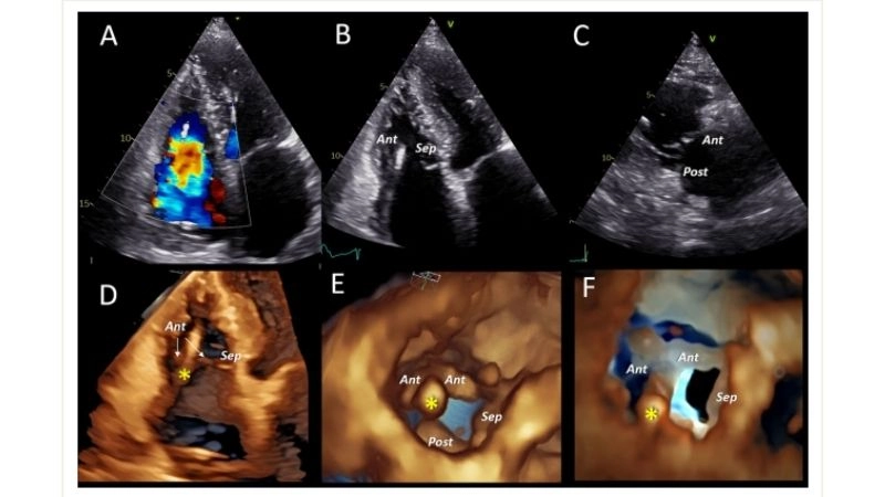 Tricuspid Regurgitation Surgery improves valve function
