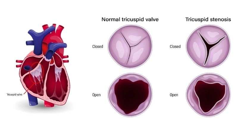 Tricuspid Stenosis Treatment helps improve blood flow