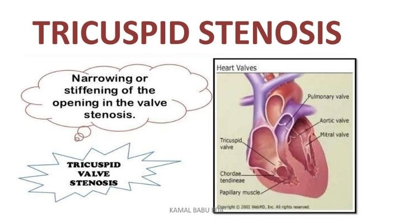 Causes Of Tricuspid Stenosis often linked with rheumatic fever