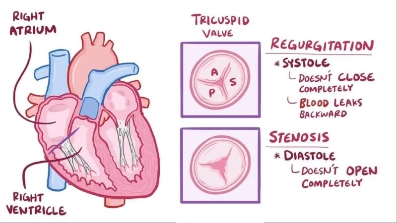 Tricuspid Stenosis Diagnosis confirmed with echocardiogram