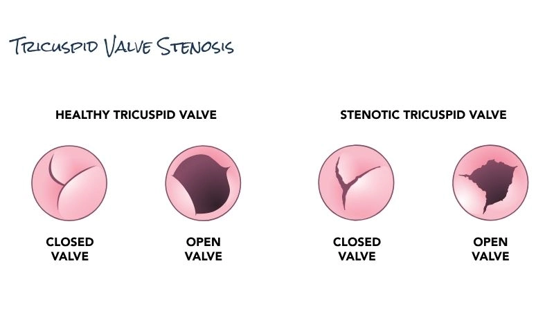 Rheumatic Heart Disease Tricuspid Stenosis common cause worldwide