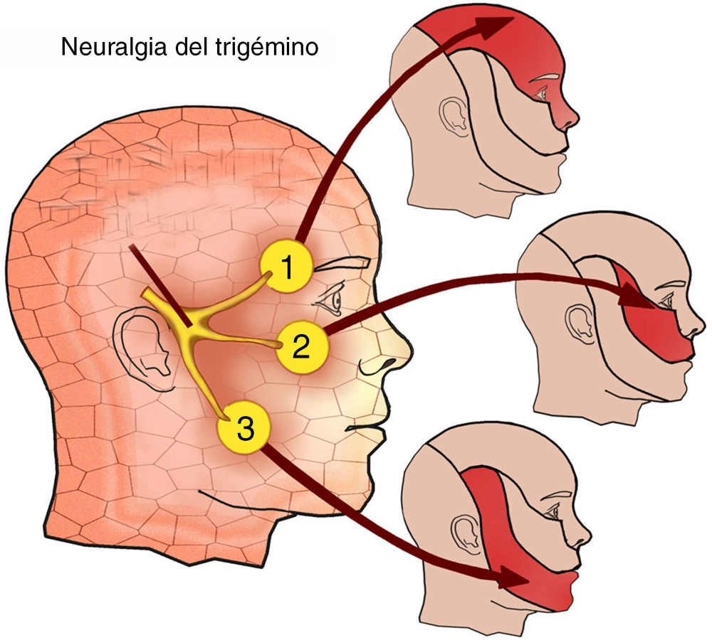 A guide to trigeminal neuralgia treatment options
