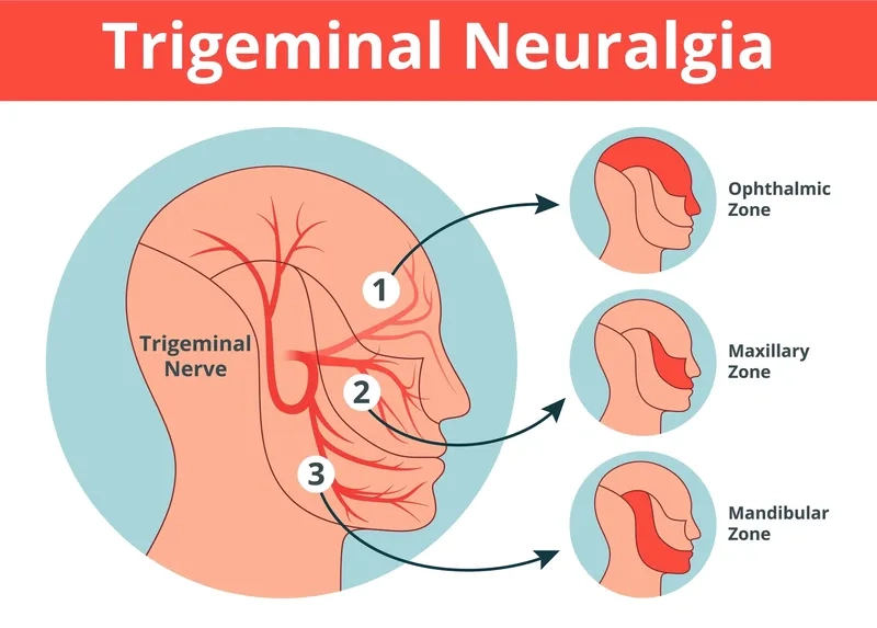 A brain scan showing trigeminal nerve compression