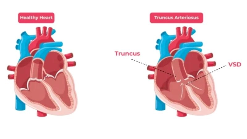 Truncus arteriosus in adults management and outlook
