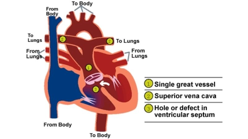 Types of truncus arteriosus classification explained