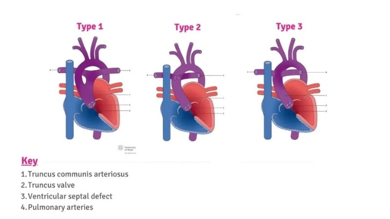Truncus arteriosus causes genetic and developmental factors