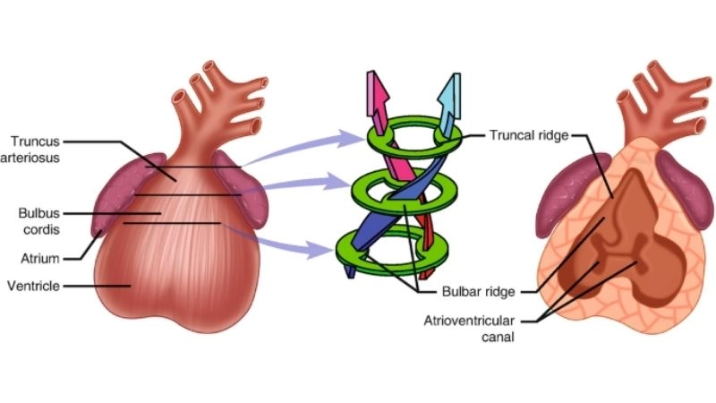 Truncus arteriosus life expectancy prognosis and survival