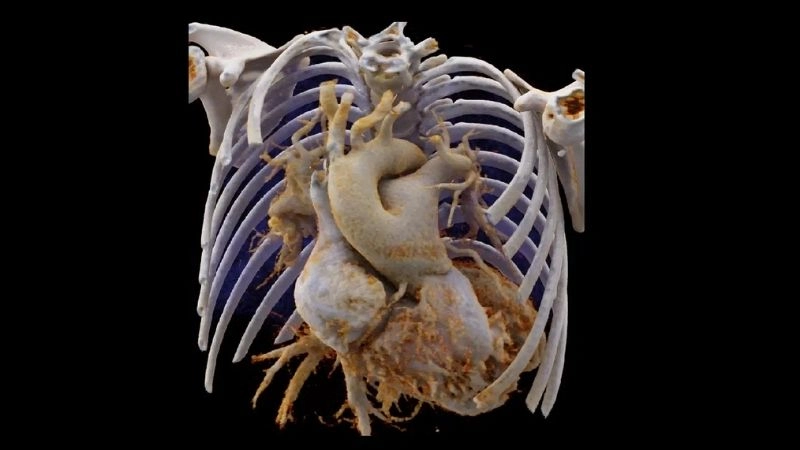 Truncus arteriosus echo role in diagnosis and follow up
