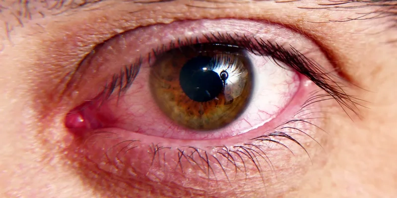 The protective tuberculosis vaccine (BCG)