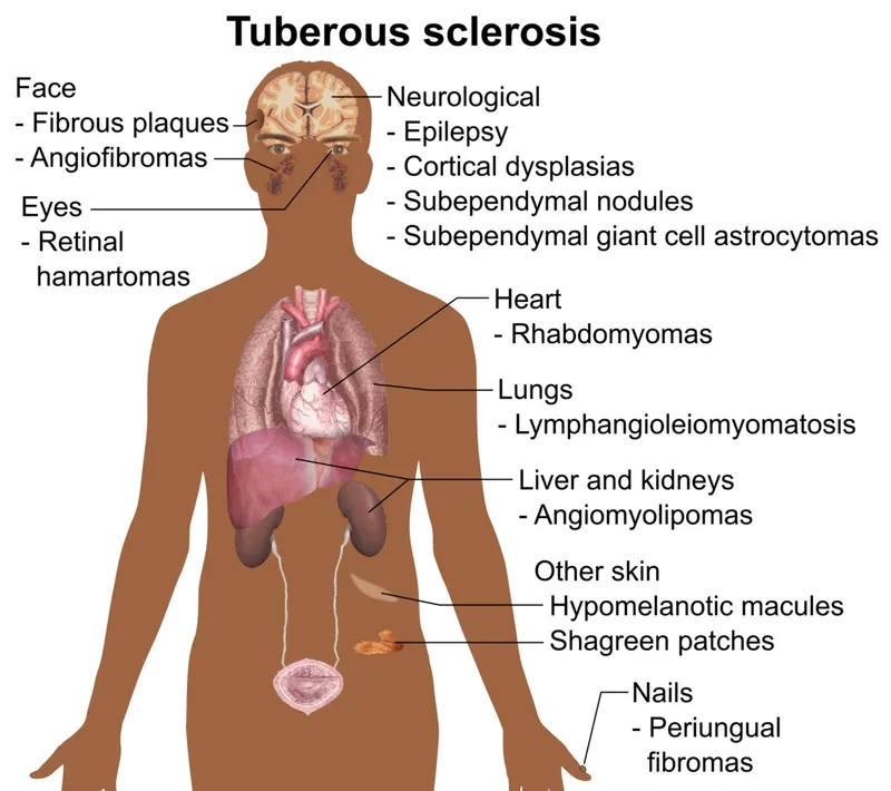Brain MRI showing tuberous sclerosis complex
