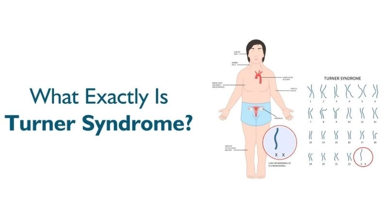 Bicuspid aortic valve Turner syndrome insights