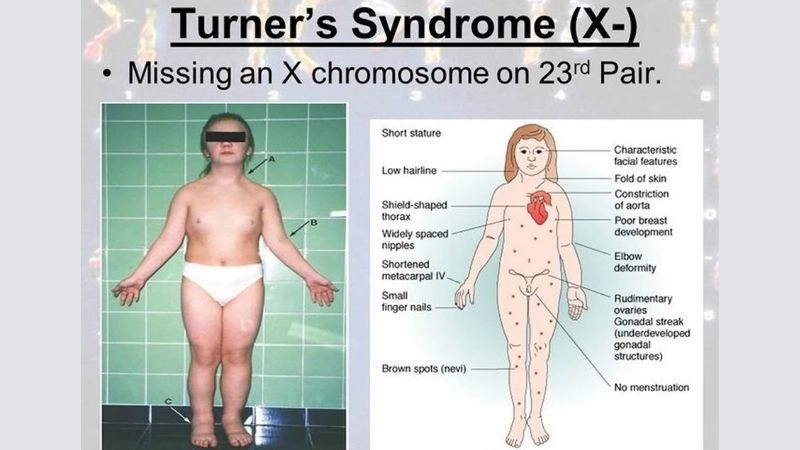 Turner syndrome heart defects in adults explained