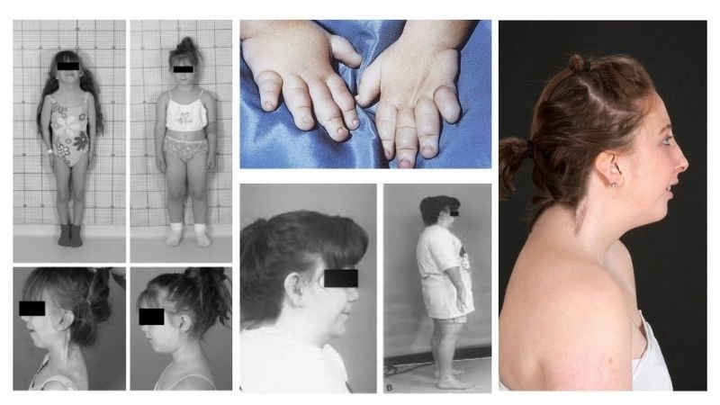 Turner syndrome and hypertension management