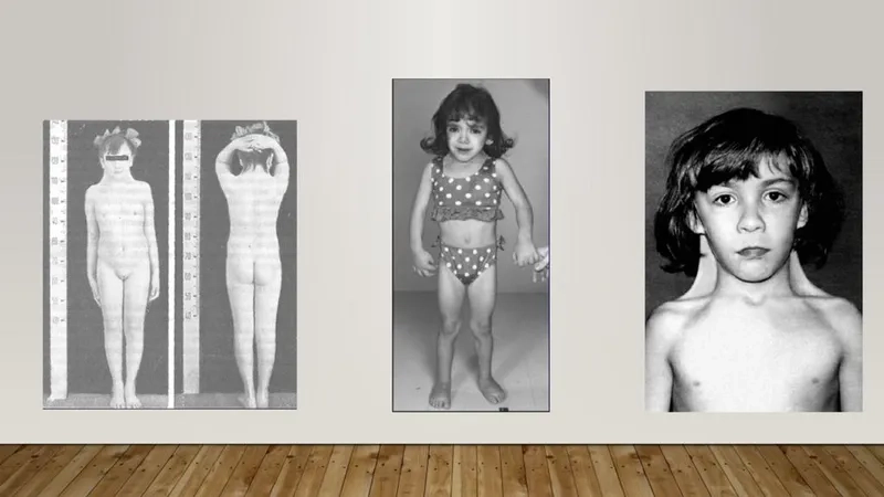 Turner syndrome symptoms and common health signs