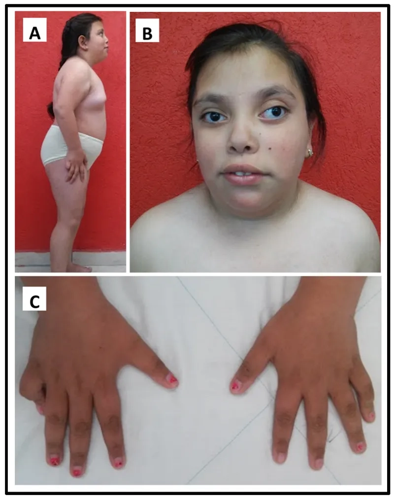 Turner syndrome life expectancy and health outlook