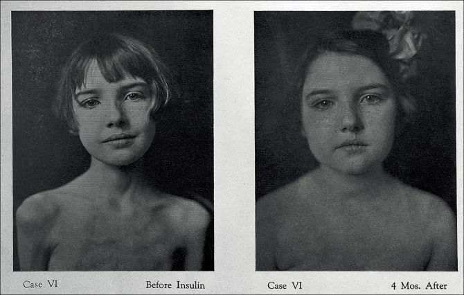 Insulin pump for diabetes management care