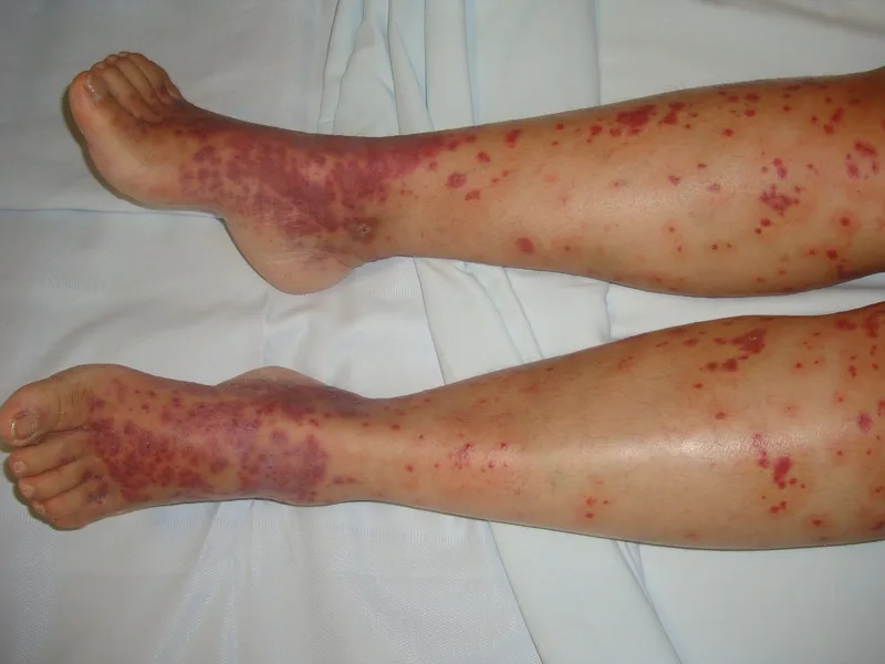 Explaining how do you get typhoid fever