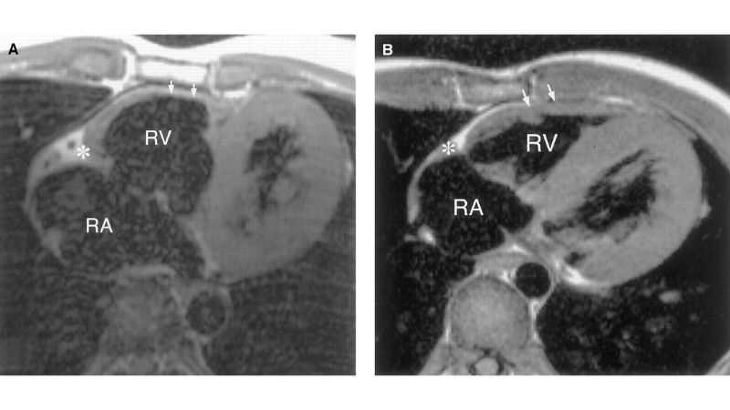 Uhl's Anomaly symptoms warning signs of right heart failure
