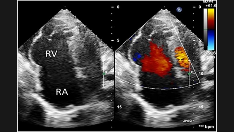 Uhl's Anomaly diagnosis accurate methods to detect disease