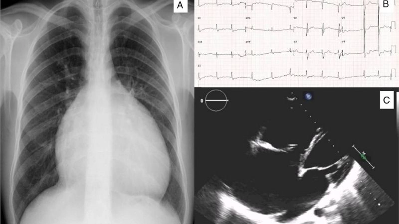 Uhl's Anomaly treatment medical and surgical interventions