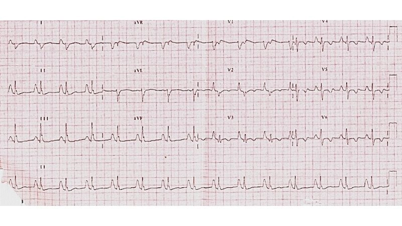Uhl's Anomaly prognosis survival outcome depends on care