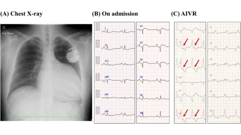 Uhl's Anomaly case report detailed documentation of rarity