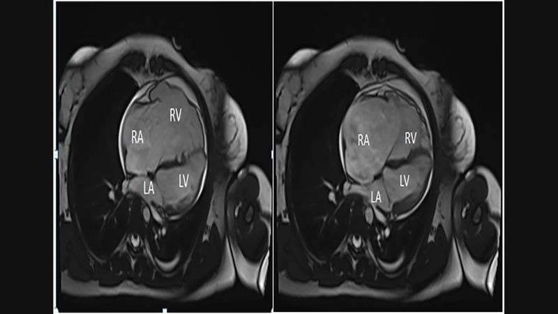 Uhl's Anomaly in infants early signs of congenital disorder