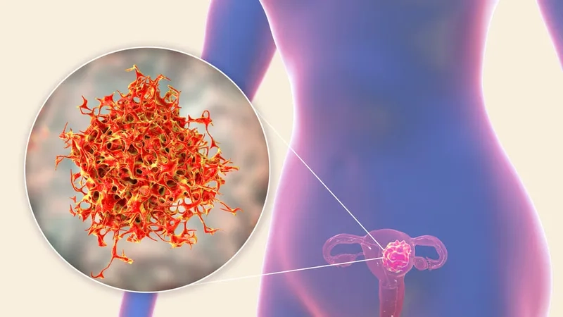 Identifying common signs of uterine cancer