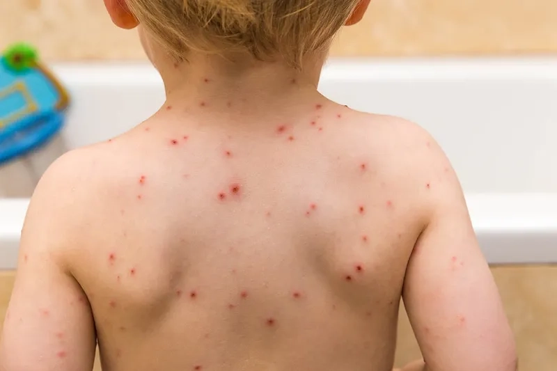 Visual guide: shingles vs chickenpox rash