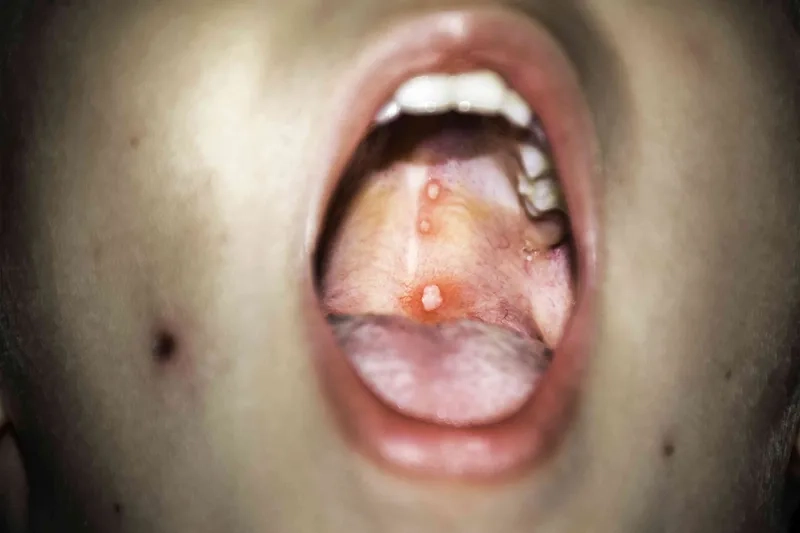 Safe chickenpox treatment for kids at home