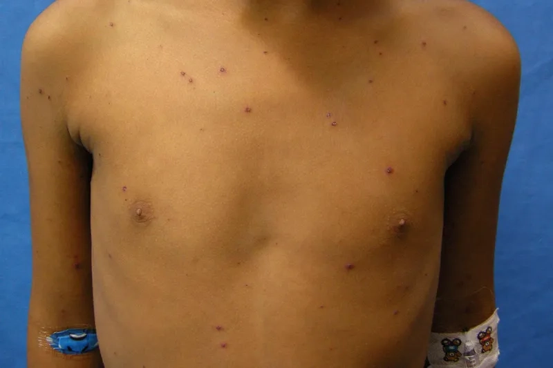 Recognizing chickenpox symptoms in adults