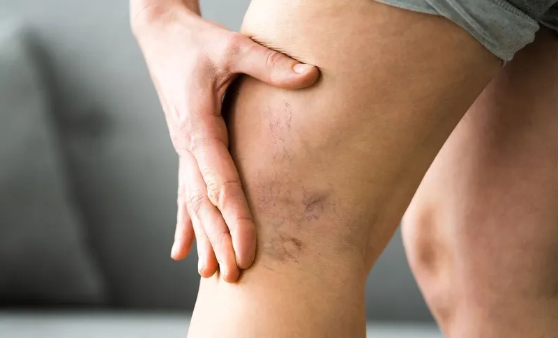 Effective Methods for Varicose Vein Pain Relief