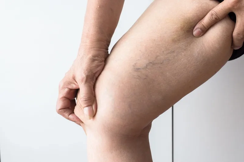 A Patient Undergoing Varicose Vein Surgery