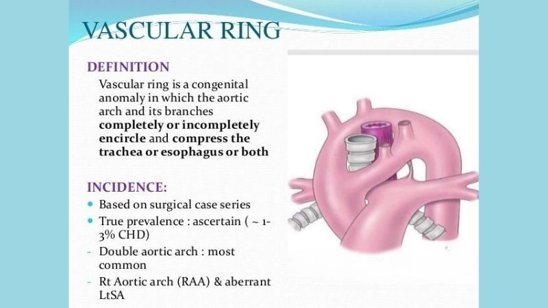 Vascular ring symptoms warning signs to recognize early