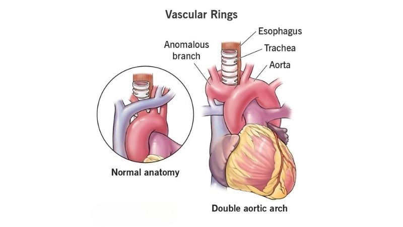 Vascular ring diagnosis imaging and clinical evaluation