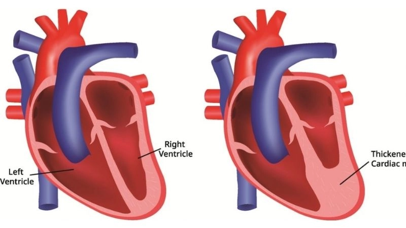 Vascular ring surgery procedures and recovery details