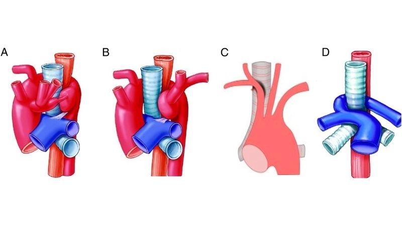 Vascular ring in babies causes symptoms and treatment